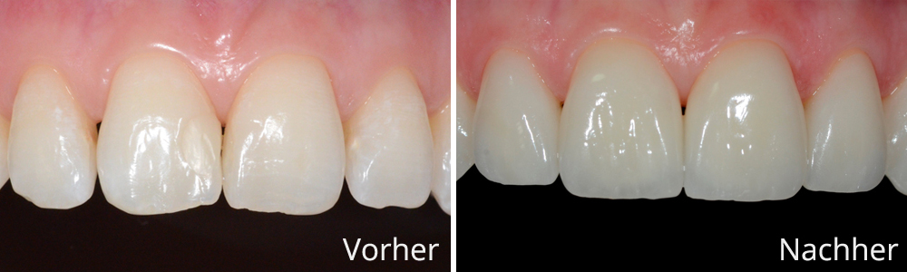 Beispiel 1: Vollkeramische Frontzahnrekonstruktion