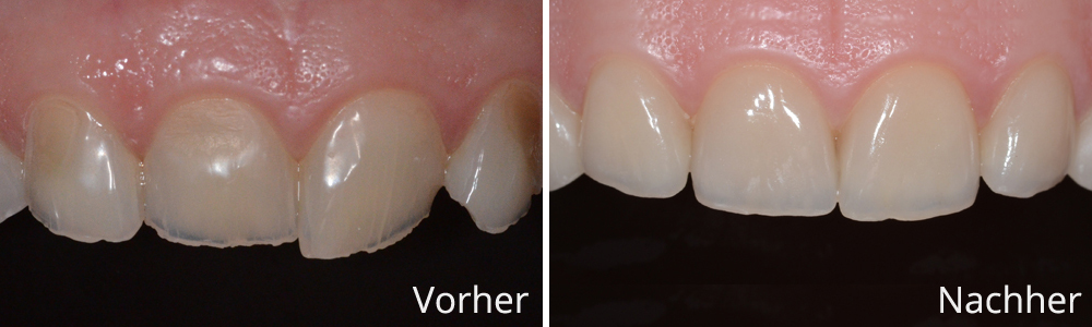 Beispiel 2: Vollkeramische Frontzahnrekonstruktion