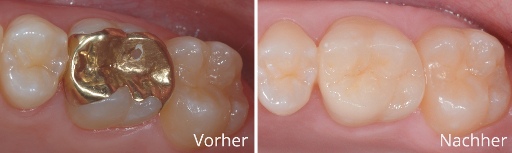Beispiel 3: Vollkeramische Seitenzahnrekonstruktion