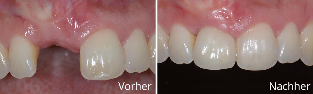 Beispiel 4: Vollkeramische Implantatrekonstruktion
